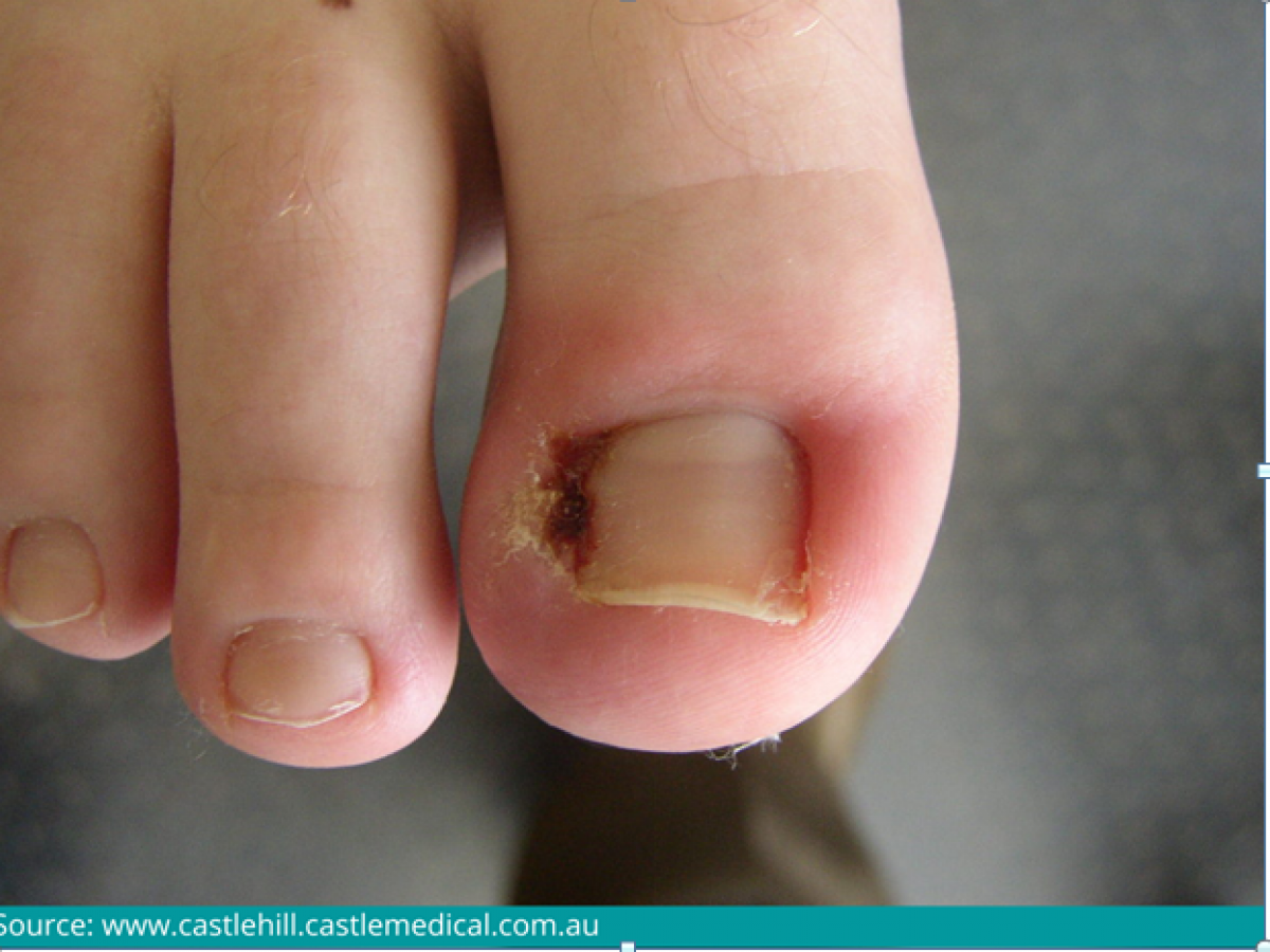 Infected Ingrown Toenail: Risk Factors and Treatments | LifeMD