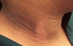 Acanthosis Nigricans – Symptoms, Causes and Treatment in Bangalore