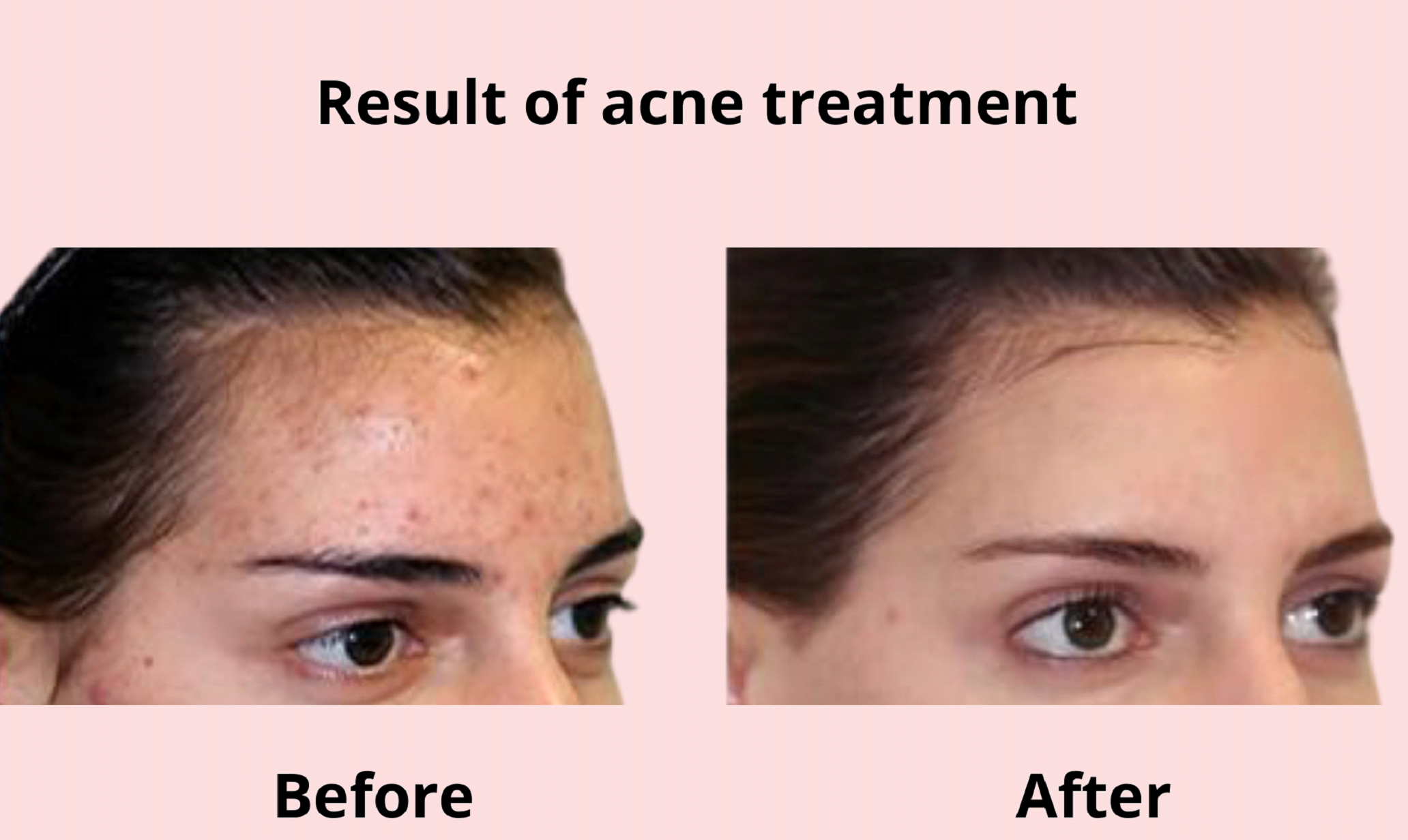 Acne after before