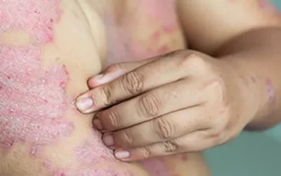 Does Psoriasis spread?