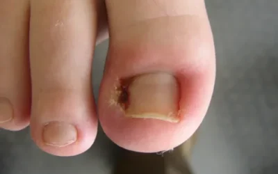 Diagnosis And Treatment For Ingrown Toenail