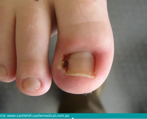 Diagnosis And Treatment For Ingrown Toenail