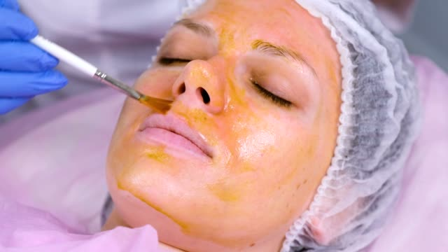 Chemical Peels