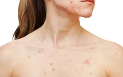 The Connection Between PCOS And Acne