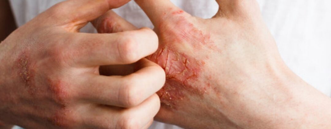 Eczema treatment and cost in Bangalore