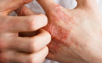 Eczema treatment and cost in Bangalore