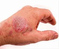 What are the factors that trigger Eczema?