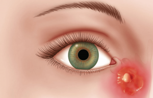 Lower-Eyelid