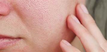 Is it possible to minimize open pores?