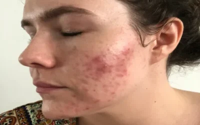 6 Factors That Might Be Causing Your Acne