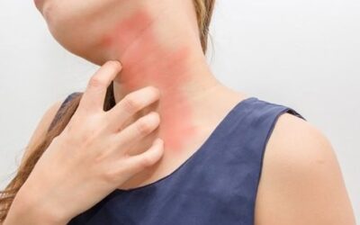 Best Skin Allergy Treatment in Indiranagar, Bangalore