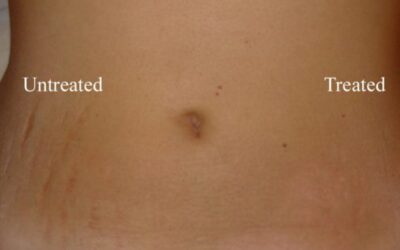 Stretch marks removal treatment in Bangalore