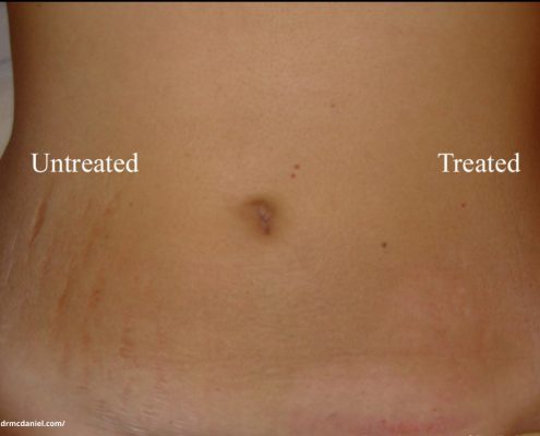 Stretch marks removal treatment in Bangalore