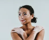 Exploring Vitiligo Treatment Options and their Costs