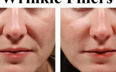 Things you should know about Wrinkle Fillers