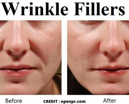 Things you should know about Wrinkle Fillers