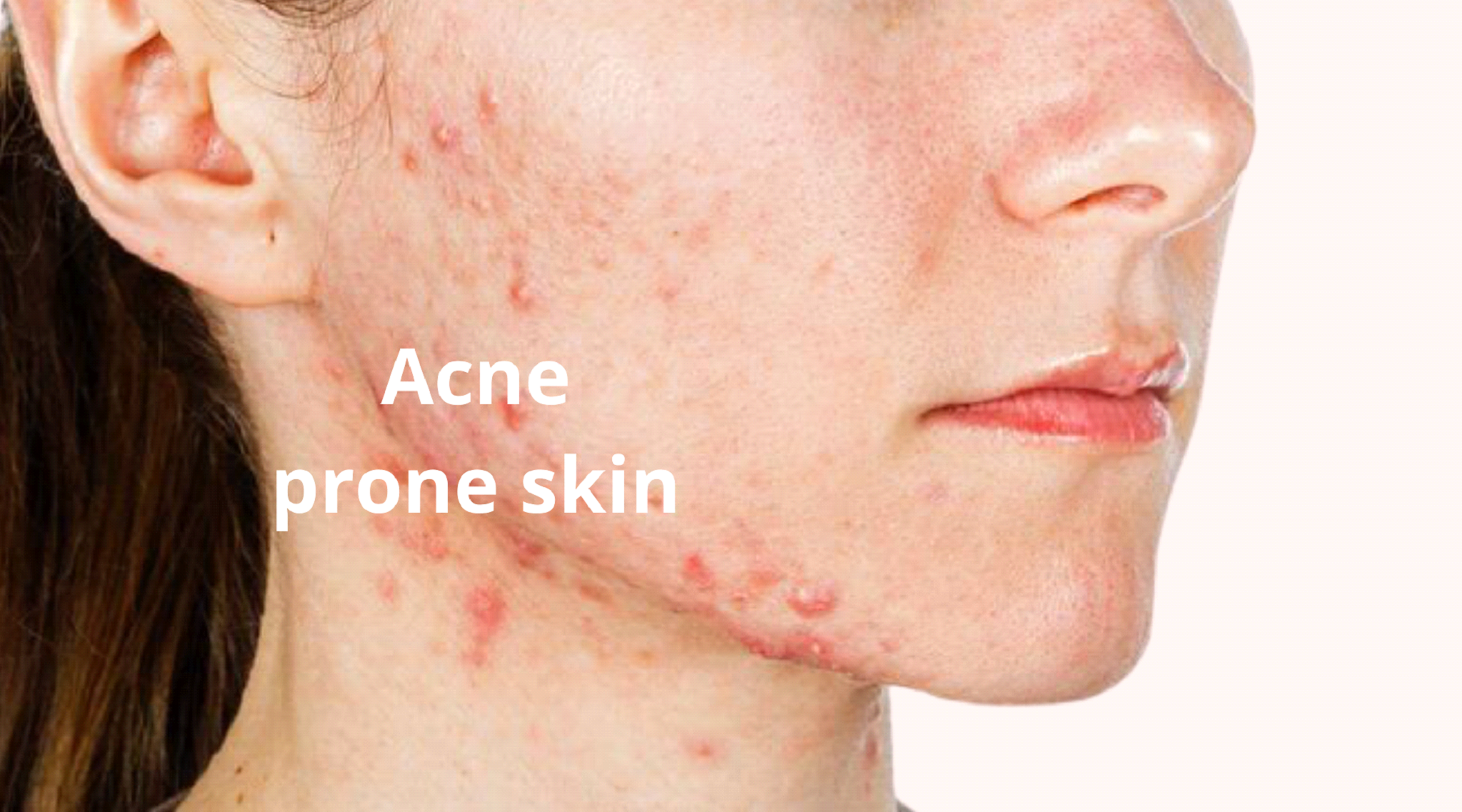 acne prone skin