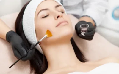 Chemical Peels for Youthful Skin