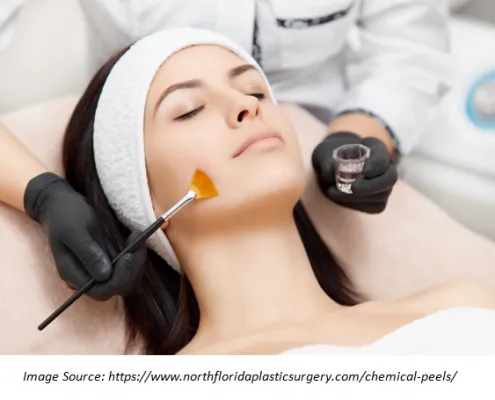 Chemical Peels for Youthful Skin