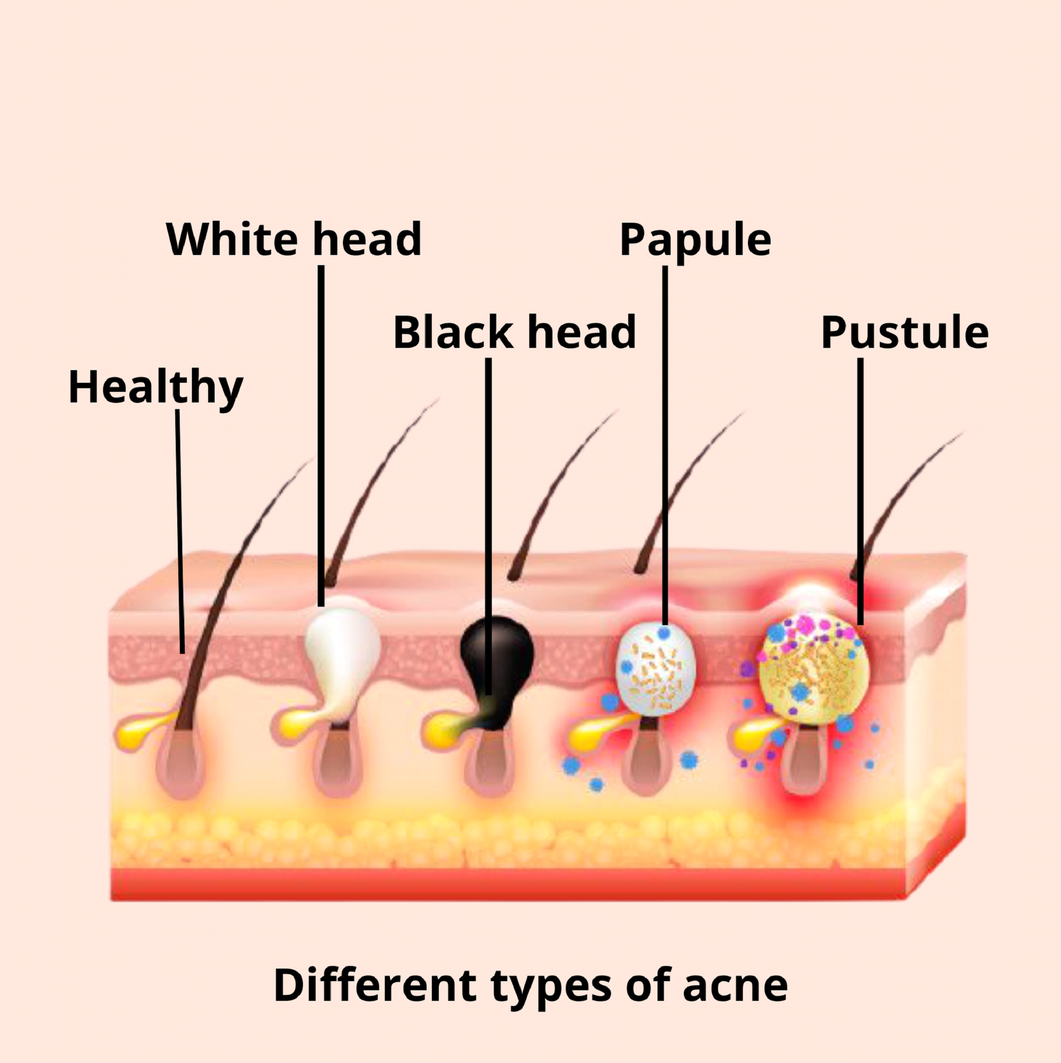 development of acne