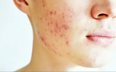 Skin Care Products to Get Rid of Acne