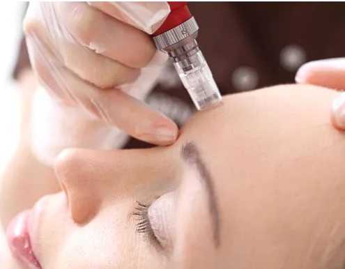 Can Mesotherapy Work Wonders For Your Skin?