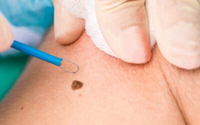 Warts and Moles Removal Treatment – All you need to know