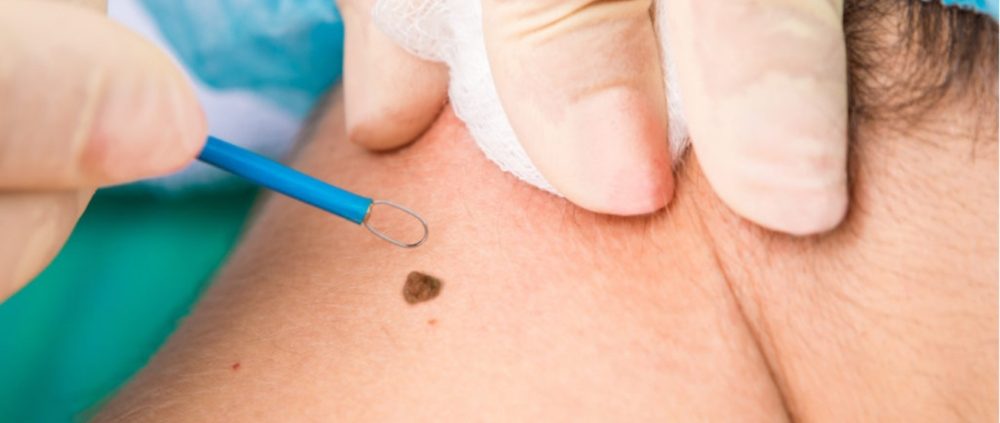 Warts and Moles Removal Treatment – All you need to know