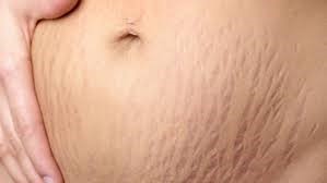 Is there any remedy for stretch marks?