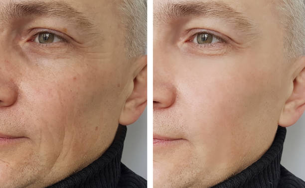 Benefits of Botox for men