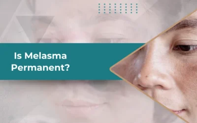 Is Melasma Permanent? Understanding Causes, Treatment, and Prevention