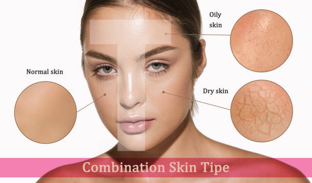 Dry Skin:</p>
<p>Dry skin tends to become flaky, itchy, and rough in winter due to a lack of natural oils. It requires rich, hydrating creams and products that lock in moisture.