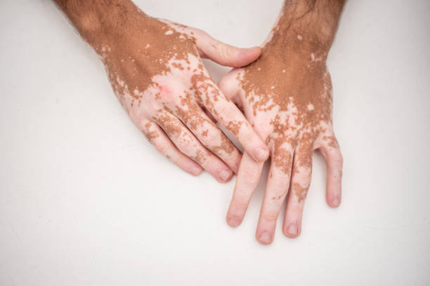 What is Vitiligo?