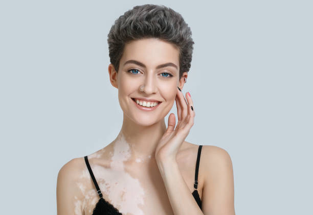 What Distinguishes Segmental Vitiligo?