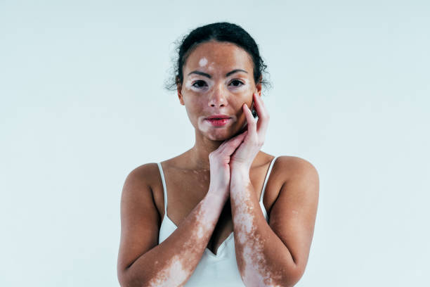 What Distinguishes Non-Segmental Vitiligo?