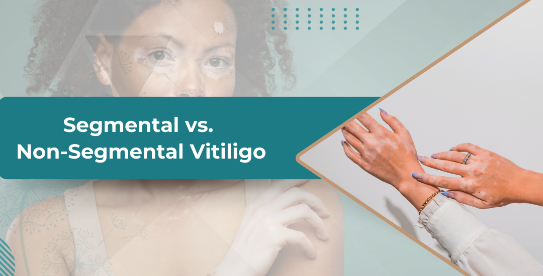 Two Faces of Vitiligo: Segmental vs. Non-Segmental