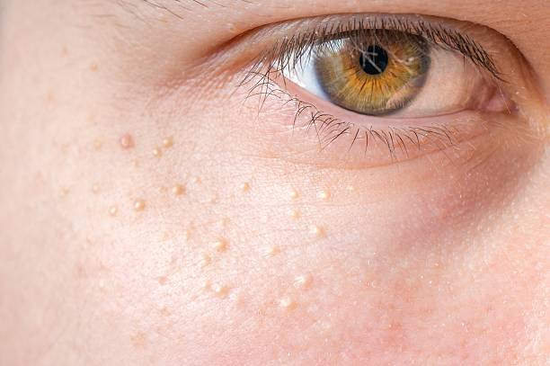 Milia: Tiny White Bumps – What Are They?