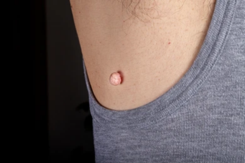 Skin Tags: Those Fleshy Growths