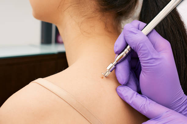 How to Get Rid of Skin Tags