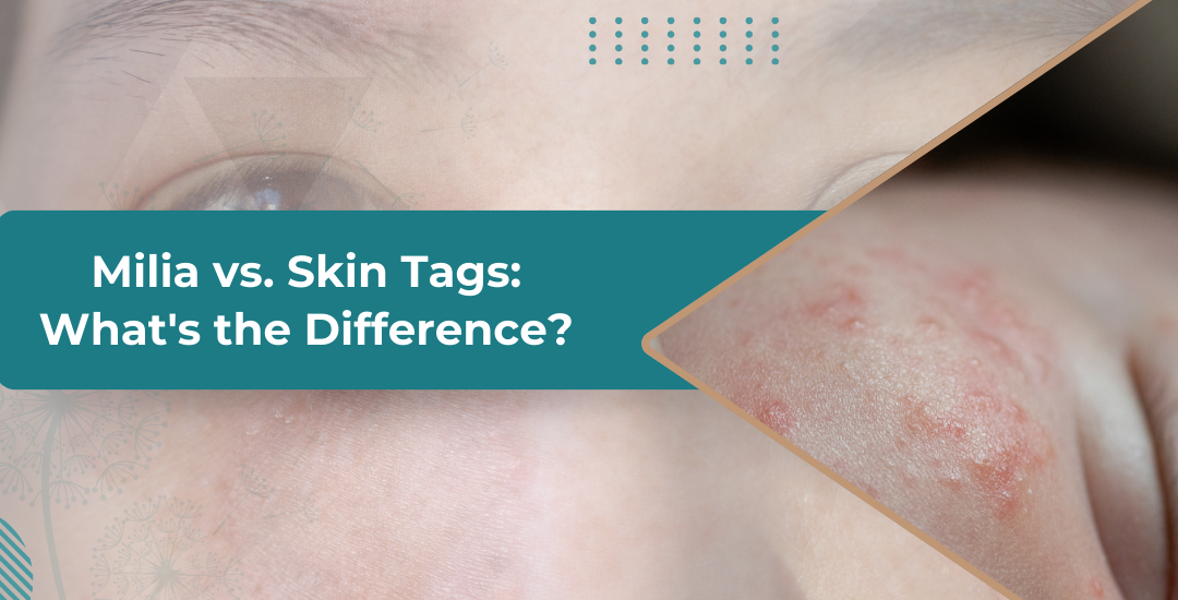 Milia vs. Skin Tags: What’s the Difference?