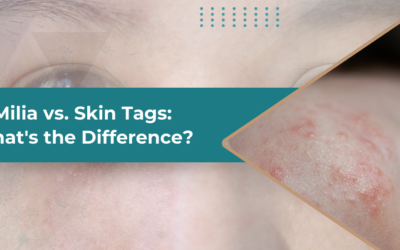 Milia vs. Skin Tags: What’s the Difference?