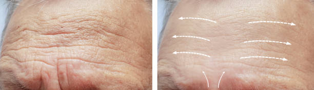 Reduces Fine Lines and Wrinkles