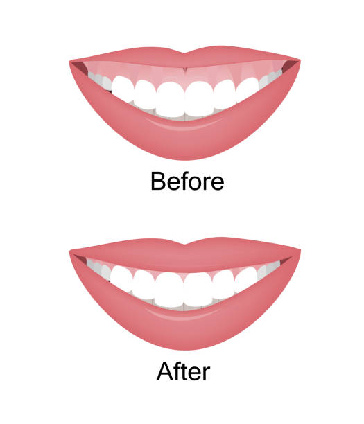 Improves Gummy Smile