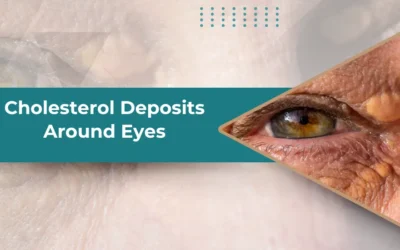How to Get Rid of Cholesterol Deposits Under Eyes?