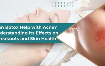 Can Botox Reduce Acne? Exploring Its Impact on Breakouts and Skin Health