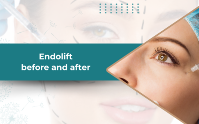 Endolift Before and After Results