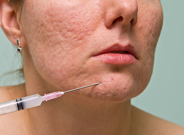 Picture10 | Dr Swetha Cosmodermcentre Close-up of a woman’s lower face with acne scarring; a syringe needle is about to inject into her chin for treatment.