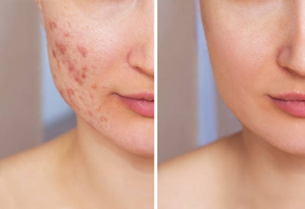 HydraFacial