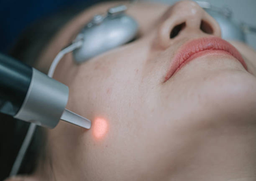 Picture22 | Dr Swetha Cosmodermcentre Close-up of a person receiving facial laser treatment; a handheld laser touches the cheek while protective goggles are worn for safety.