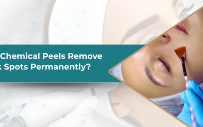 Can Chemical Peels Remove Dark Spots Permanently?